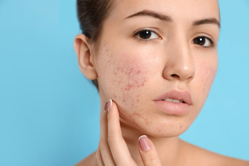 Acne on face